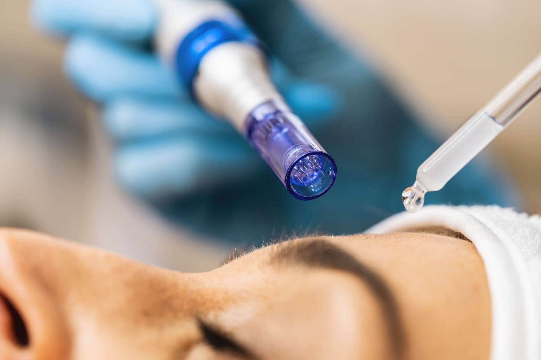 microneedling for sun damage